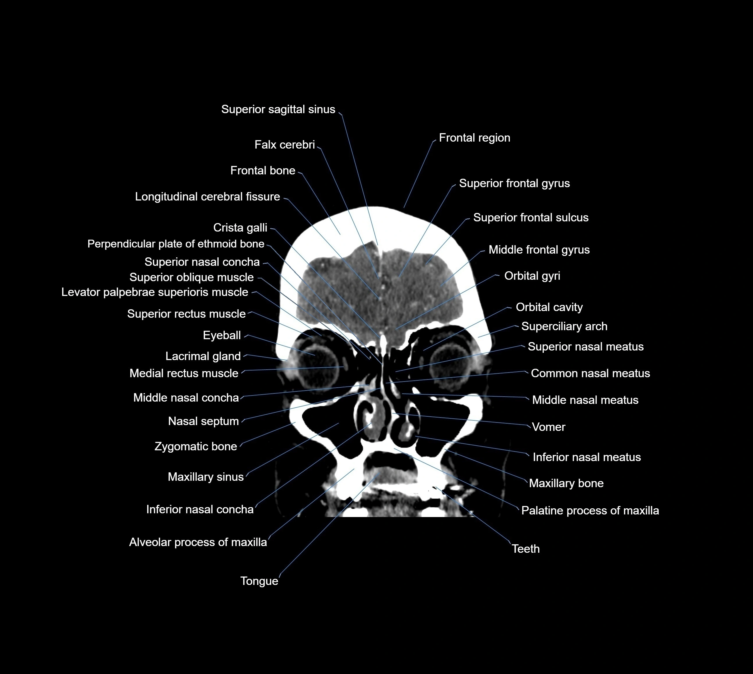 CT Brain coronal cross sectional radiology anatomy image  -img-00001-09.webp